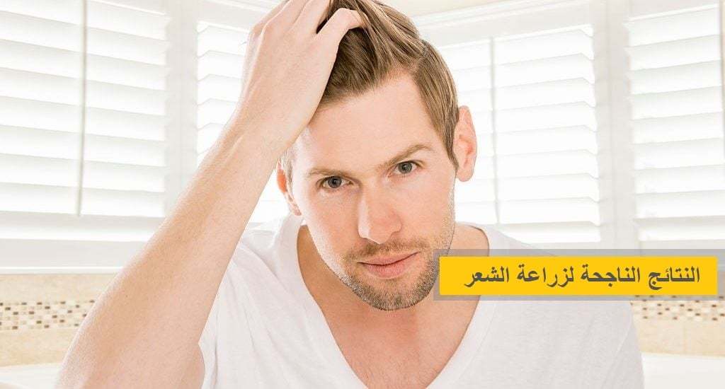 Başarılı-Saç-Ekimi-Sonuçları-1-1024x550