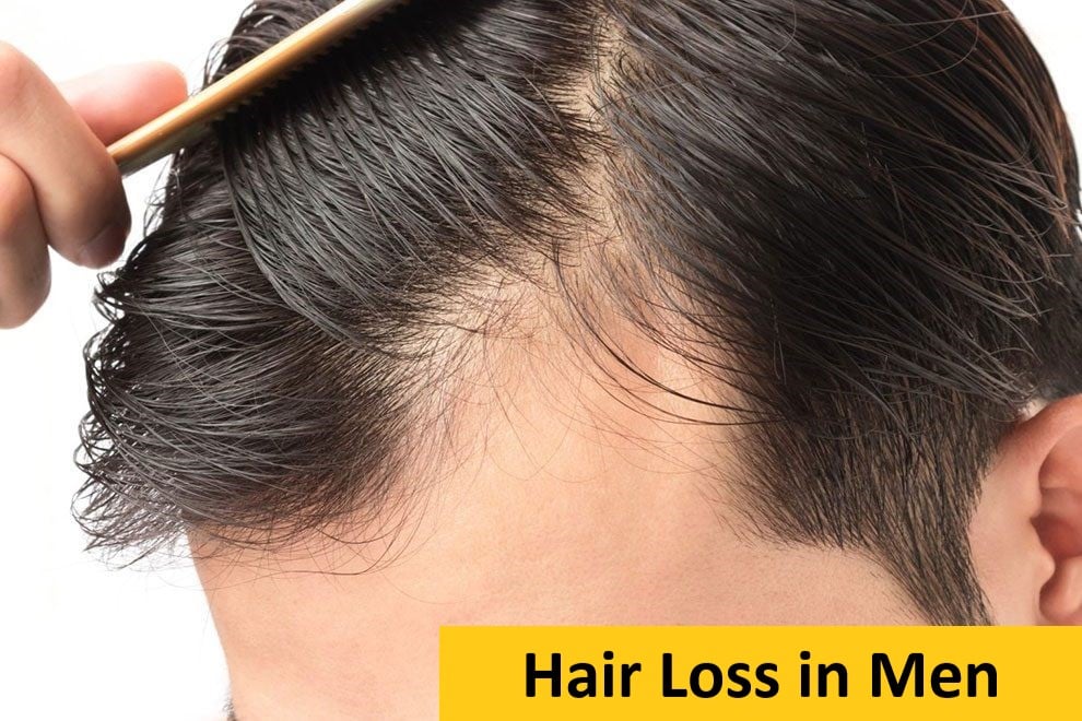 Hair Loss in Men