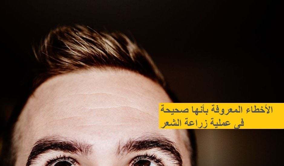 SAÇ-EKİMİNDE-DOĞRU-BİLİNEN-YANLIŞLAR-1-939x550