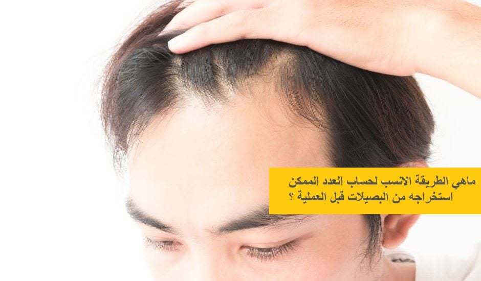 Saç-Ekimi-Öncesi-Graft-Hesabı-Nasıl-Yapılmalı-940x550