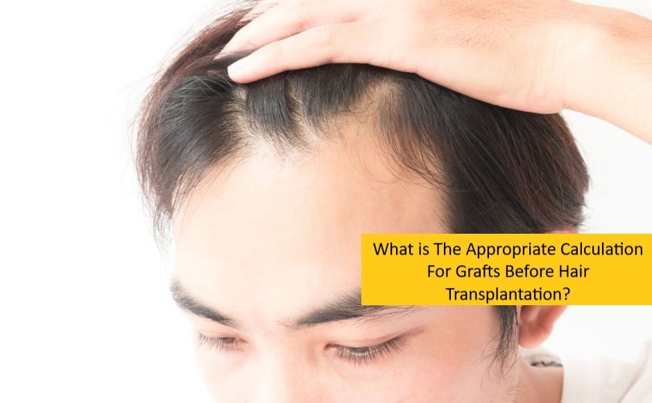 What is The Appropriate Calculation For Grafts Before Hair Transplantation